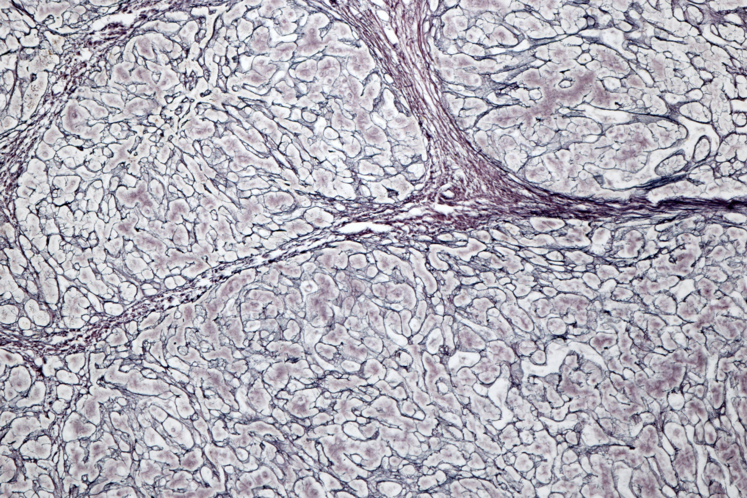 Microscopic view of liver tissue showing cirrhosis, highlighting NAD+ research in liver disease.