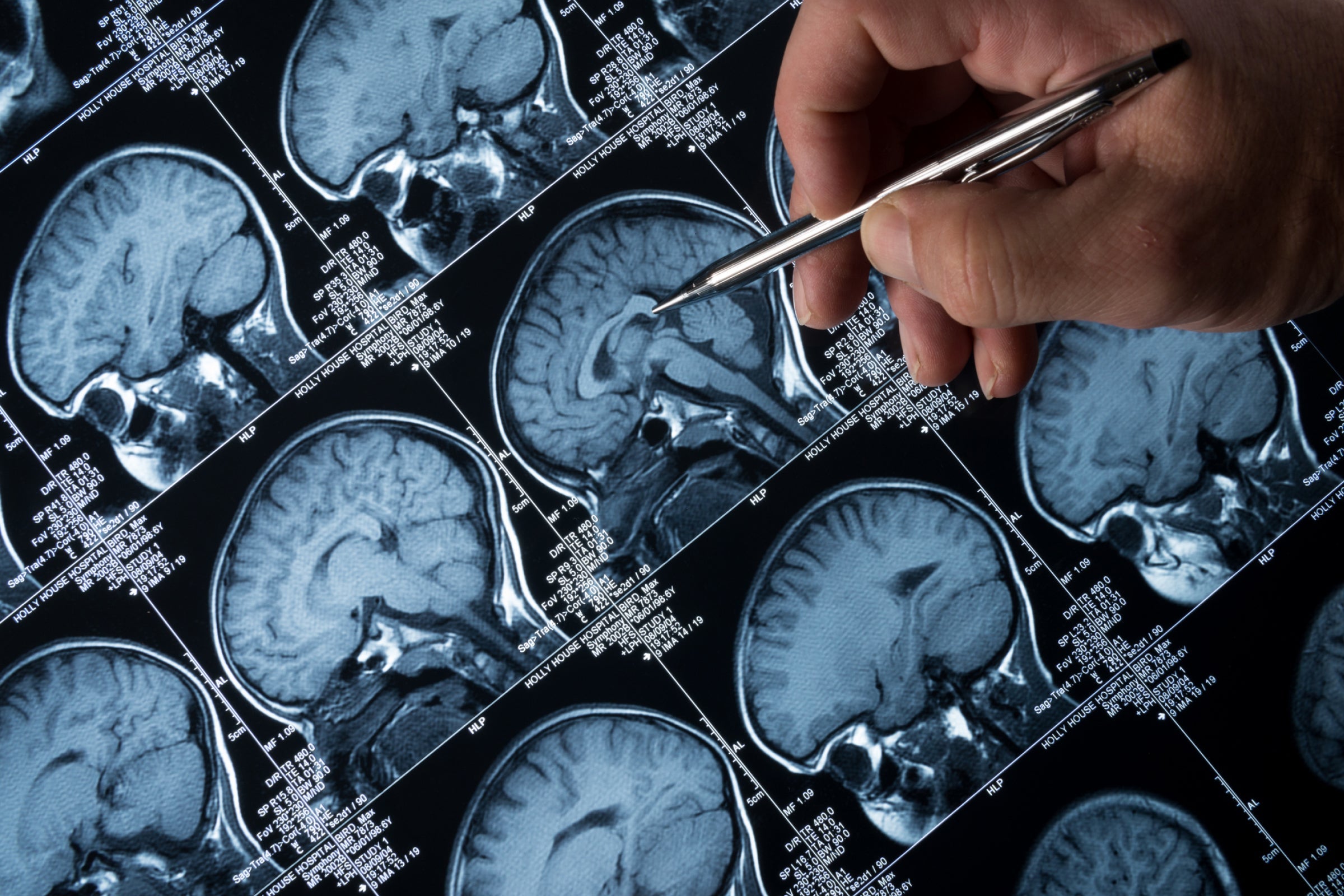 MRI brain scan representing nicotinamide riboside (NR) research on ataxia, antibody response, and neurological health.