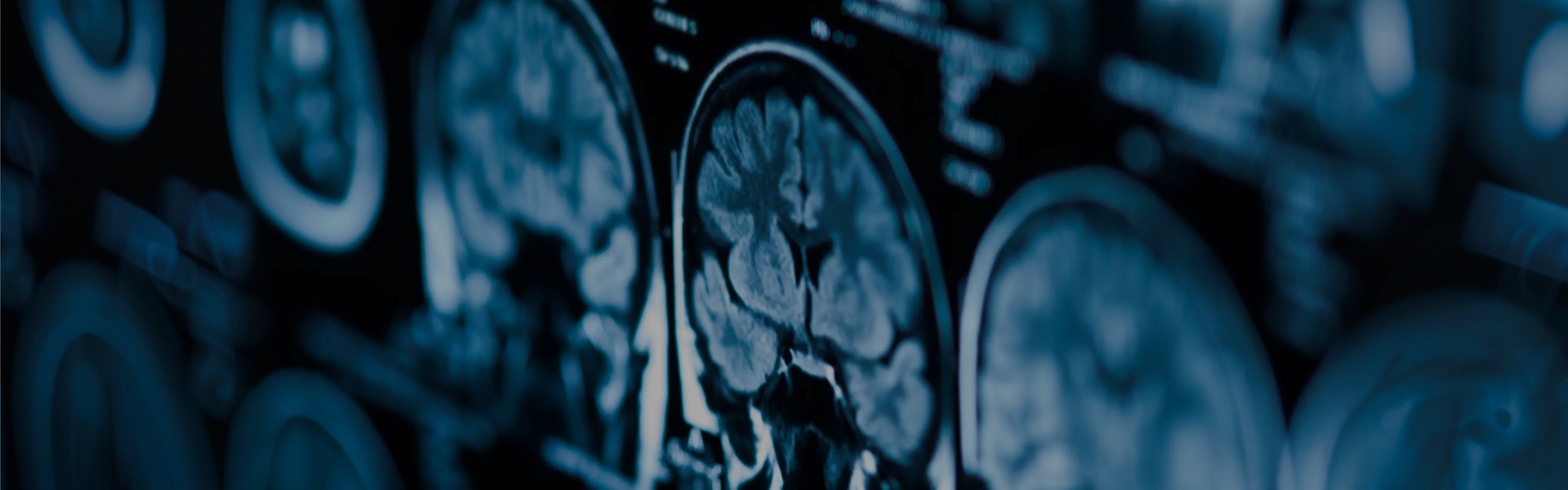 Brain MRI scan illustrating NAD+ research in Alzheimer’s, Parkinson’s, neurodegeneration, memory, and cognitive function.