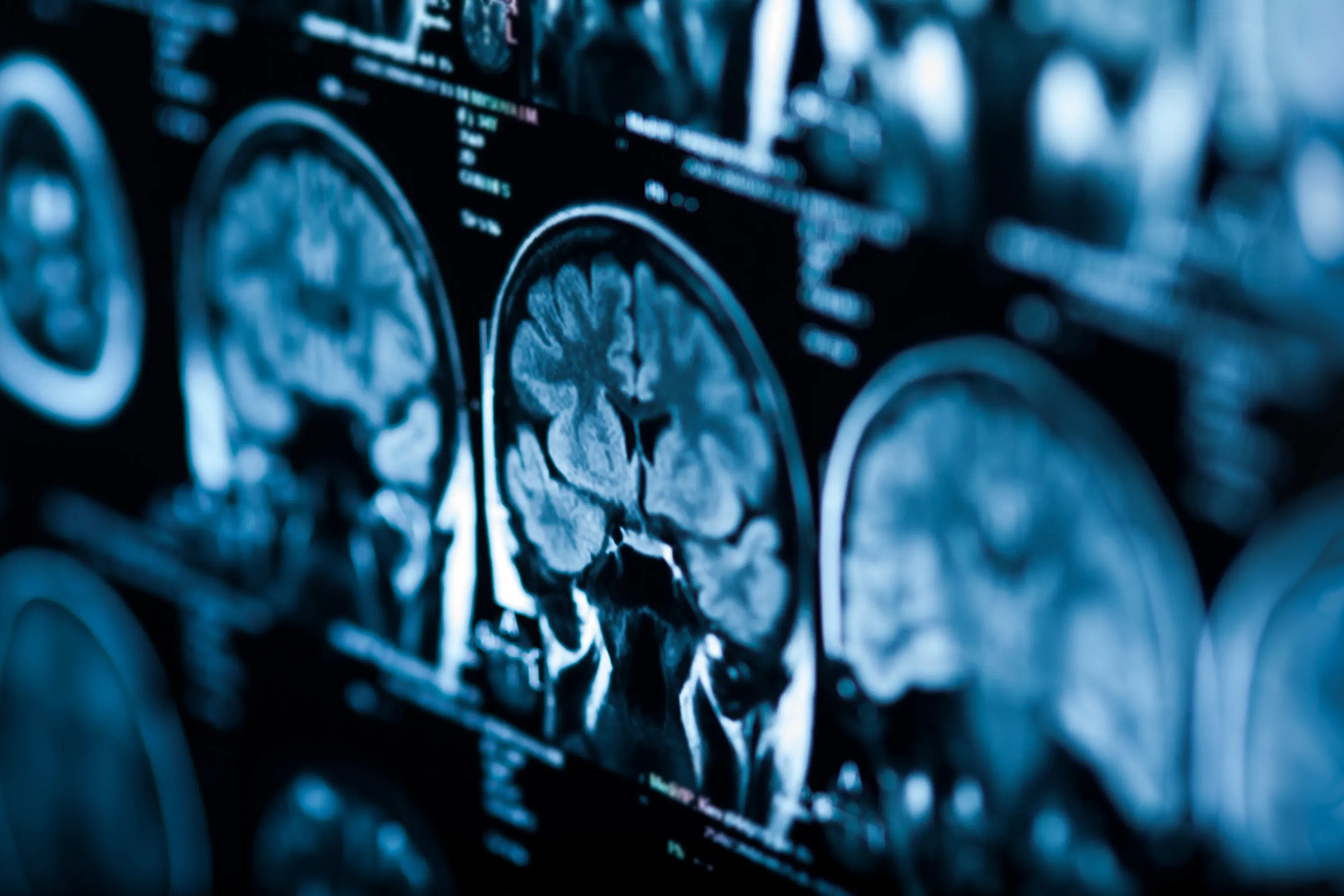 Brain MRI scan illustrating NAD+ research in Alzheimer’s, Parkinson’s, neurodegeneration, memory, and cognitive function.