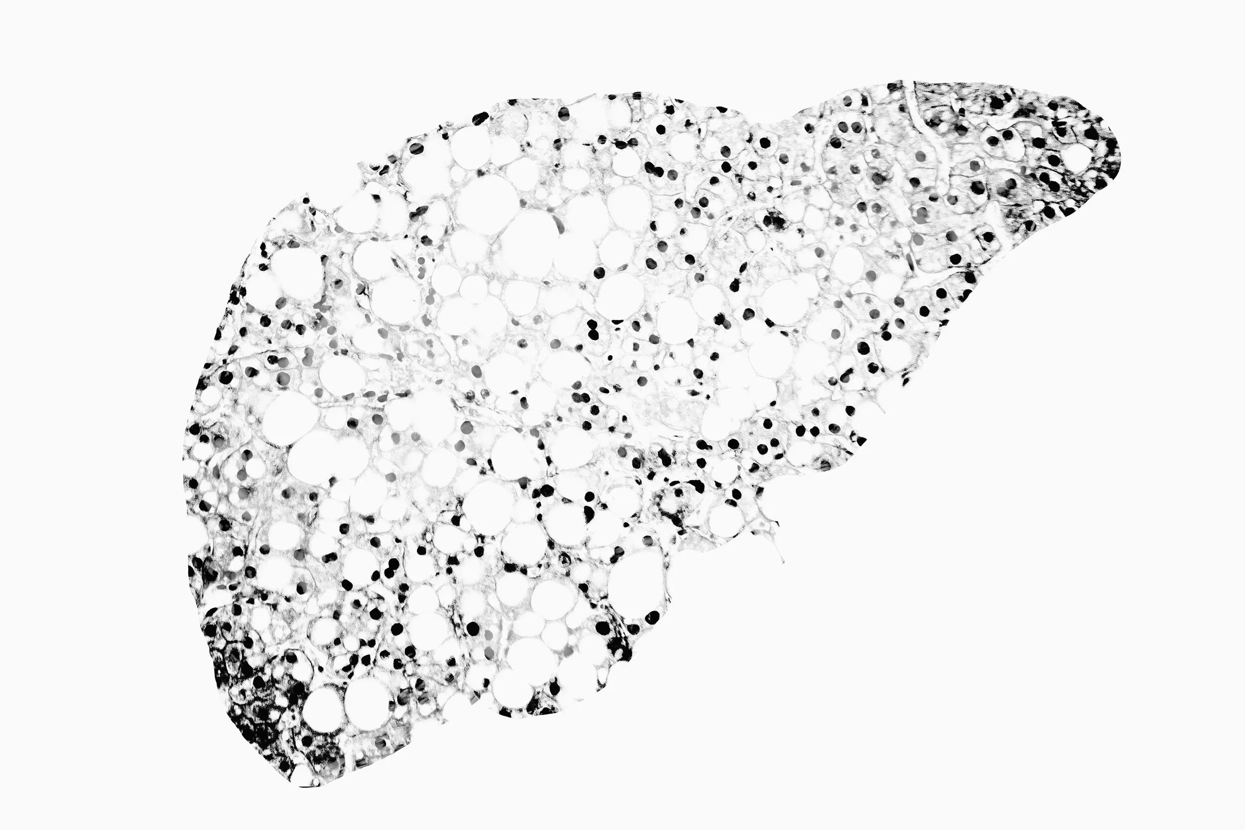 Combined Metabolic Activators Therapy Reduces Liver Fat by 10% In Nonalcoholic Fatty Liver Disease Patients