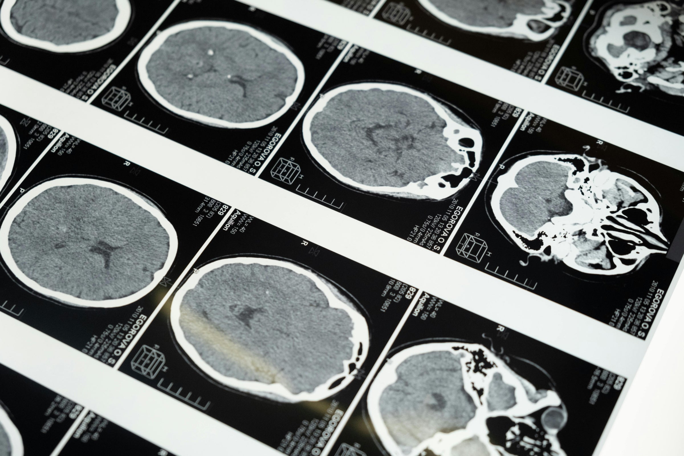 Brain MRI scans symbolizing the impact of NAD+ on brain health and neurological function.